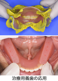 治療用義歯の応用