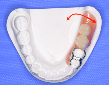 片側義歯では後方が沈み、かつ左右に動いてしまいやすい