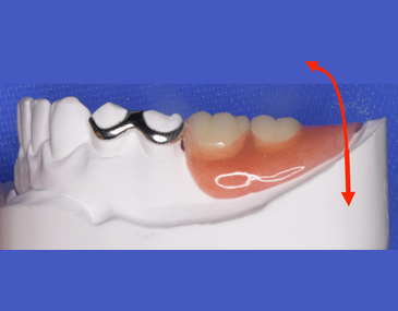 金属の通るスペース1mm程度が必要