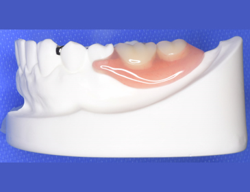 歯牙の削合は最小限で