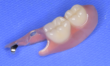 ミラクルデンチャー 費用:30万〜