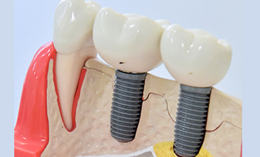 インプラント2本分 費用80〜100万円程度