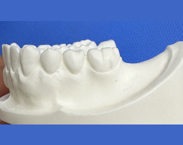一番後ろの大臼歯が1本欠損している状態