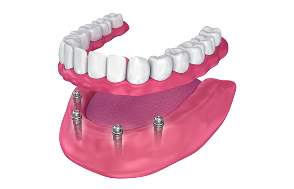 top_implant